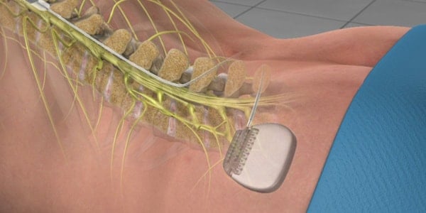 spinal cord stimulator implant abbott