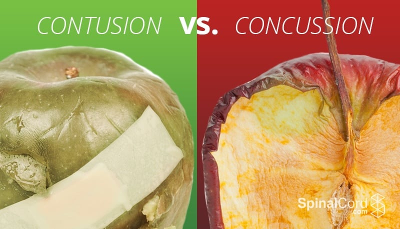 Contusion vs. Concussion Symptoms Causes and Treatment