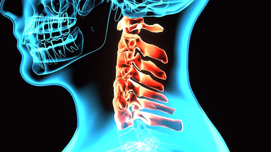 Incomplete Spinal Cord Injury | SpinalCord.com