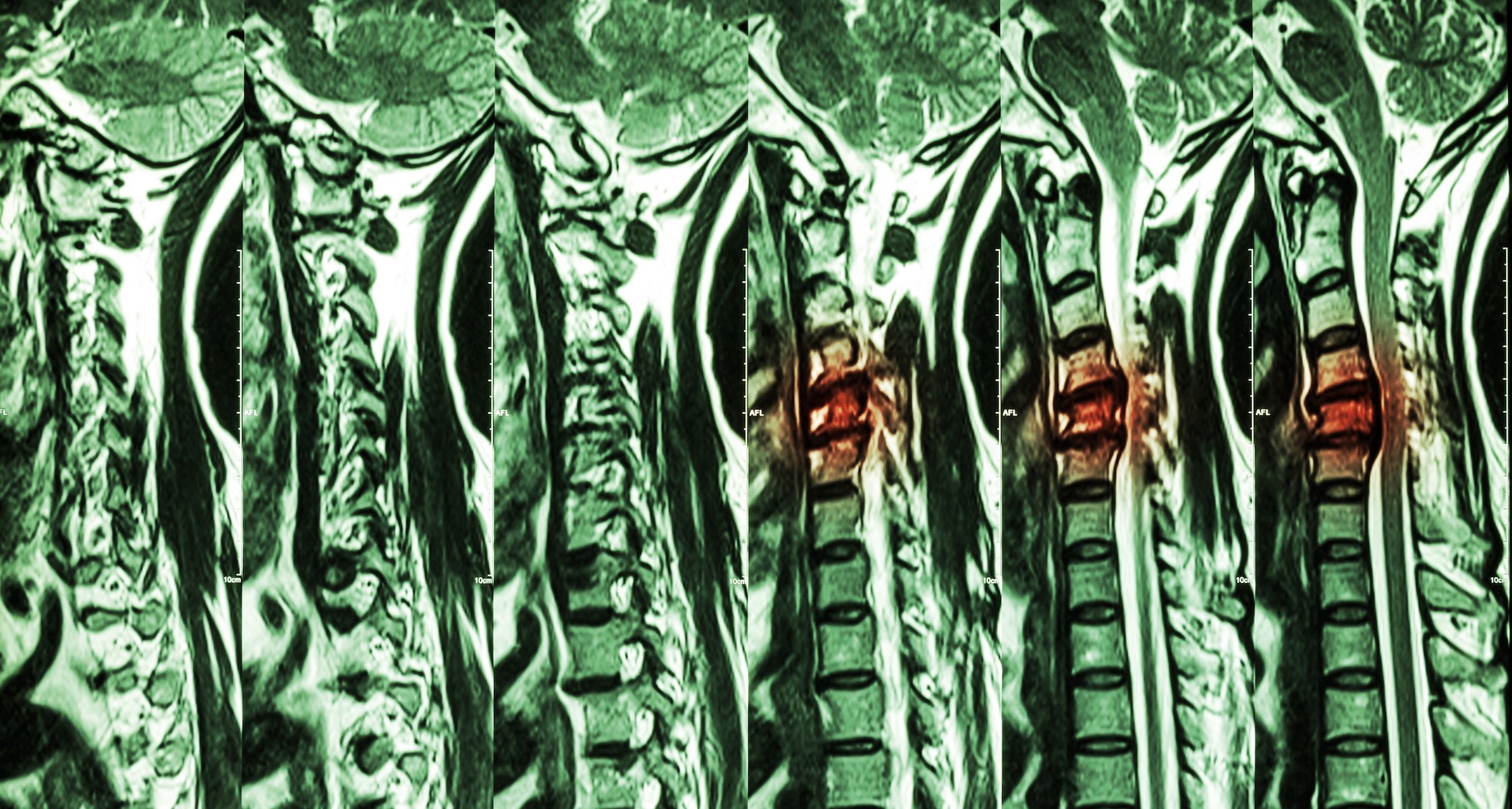 What Are The Most Common Types Of Spinal Cord Injuries