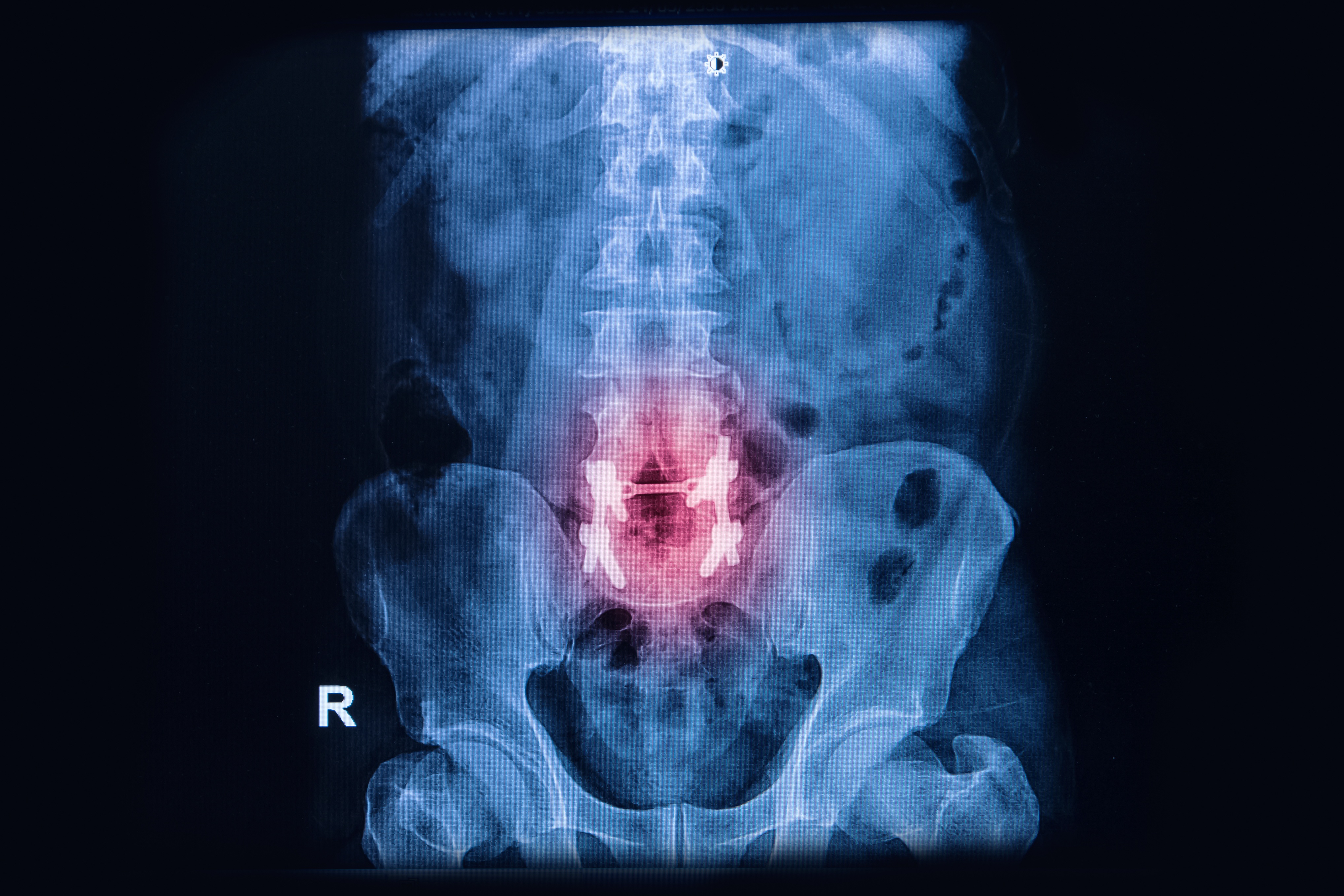 What You Need to Know About Lumbar Spinal Cord Damage