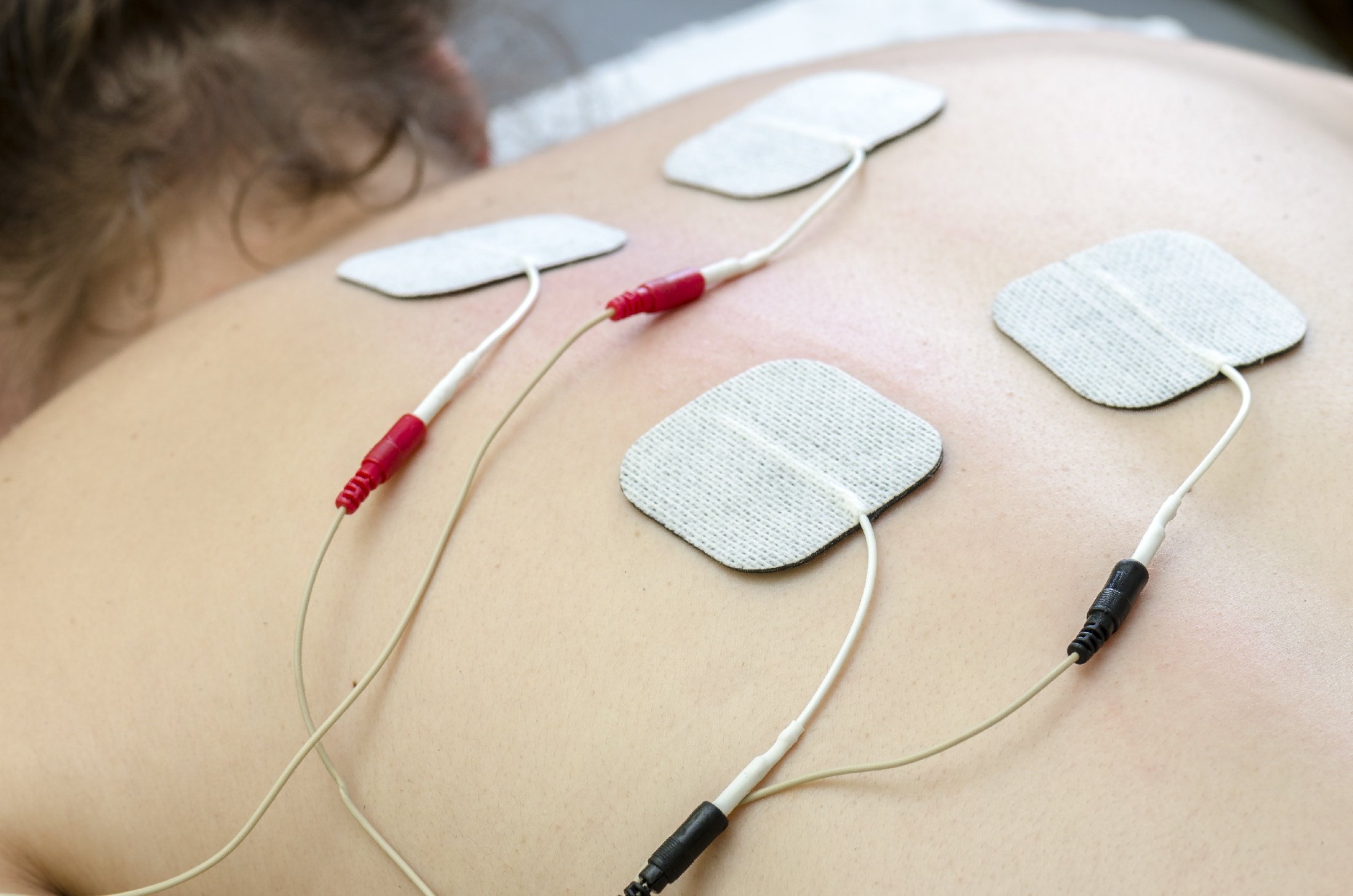 Electrical Stimulation for Spinal Cord Injury: How It Works